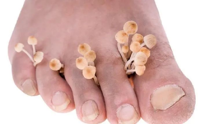 夏天容易犯腳氣，5個(gè)妙招交給你！