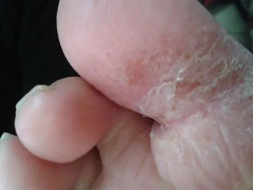 夏季足癬高發(fā)，5類(lèi)人群要注意預防！